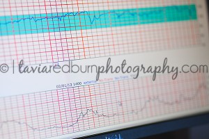 monitoring contractions in hospital birth